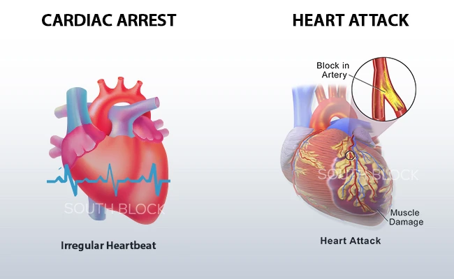 अटैक vs कार्डियक अरेस्ट : उससे जुड़ी आवश्यक जानकारी