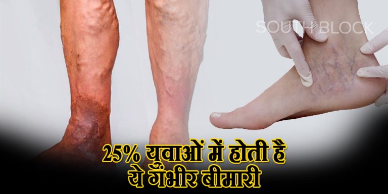 Varicose veins