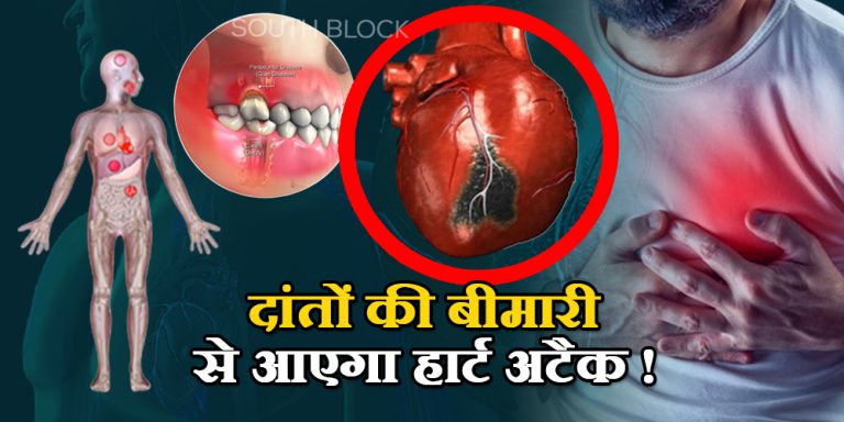 Teeth infection cause heart disease