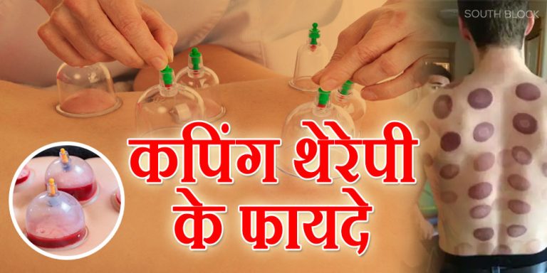 Cupping Therapy Benefits