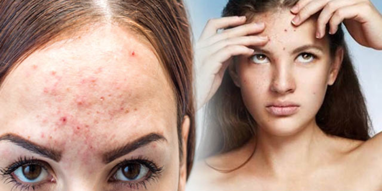 Forehead Pimples Causes