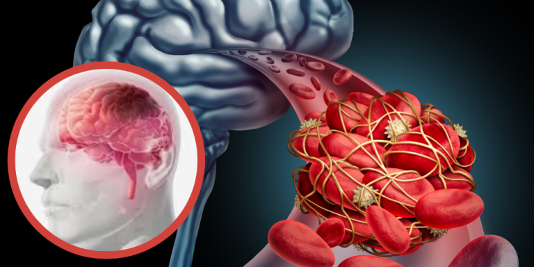 Transient Ischemic Disease