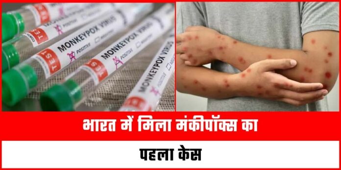 MPox Case In India